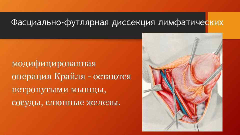 Фасциально-футлярная диссекция лимфатических модифицированная операция Крайля - остаются нетронутыми мышцы, сосуды, слюнные железы. 