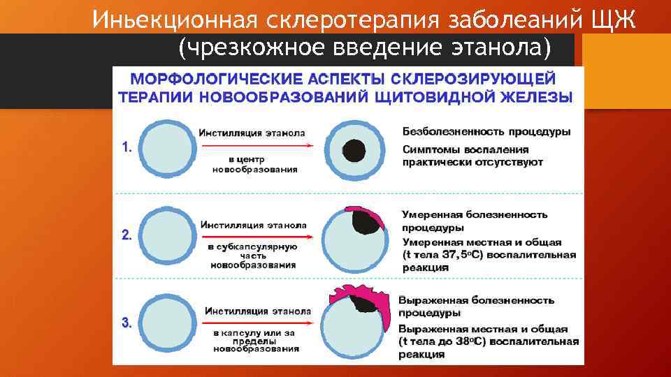 Иньекционная склеротерапия заболеаний ЩЖ (чрезкожное введение этанола) 