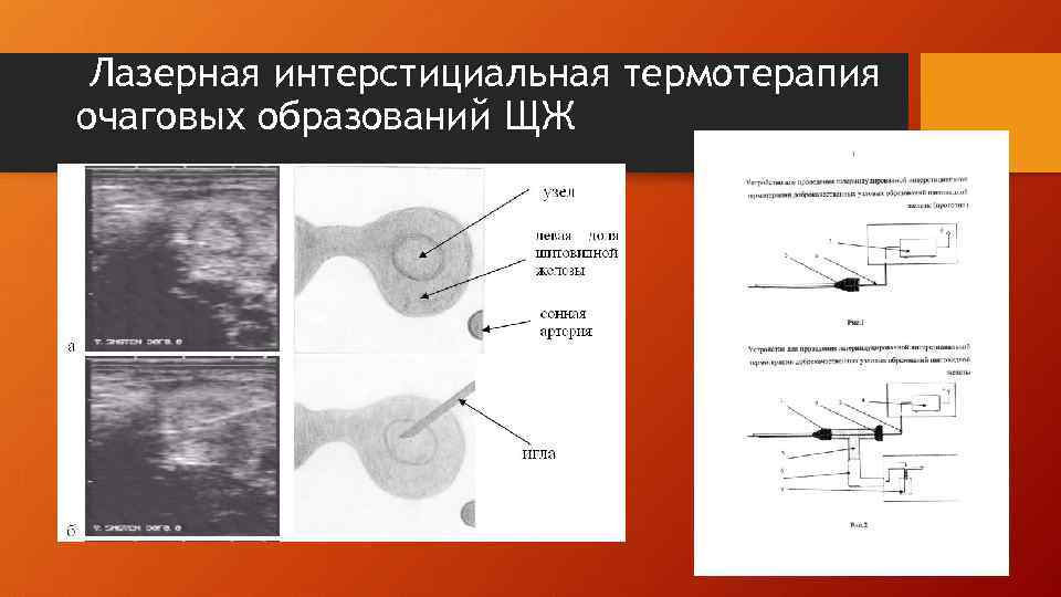 Лазерная интерстициальная термотерапия очаговых образований ЩЖ 