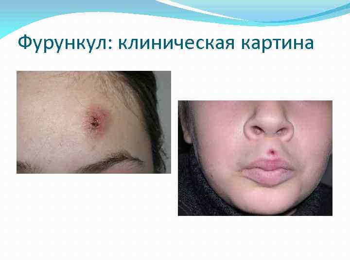 Фурункул: клиническая картина 