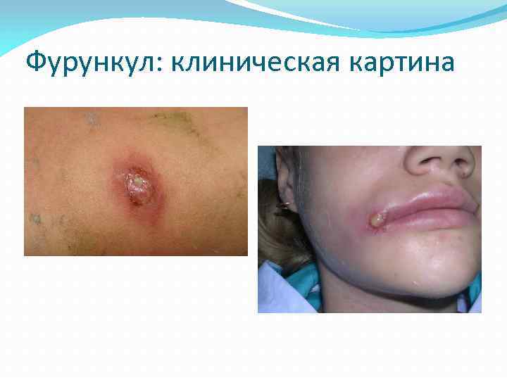 Фурункул: клиническая картина 
