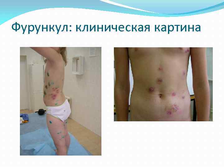 Фурункул: клиническая картина 