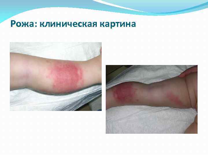 Рожа: клиническая картина 