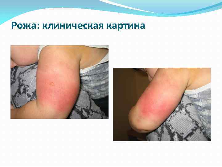 Рожа: клиническая картина 