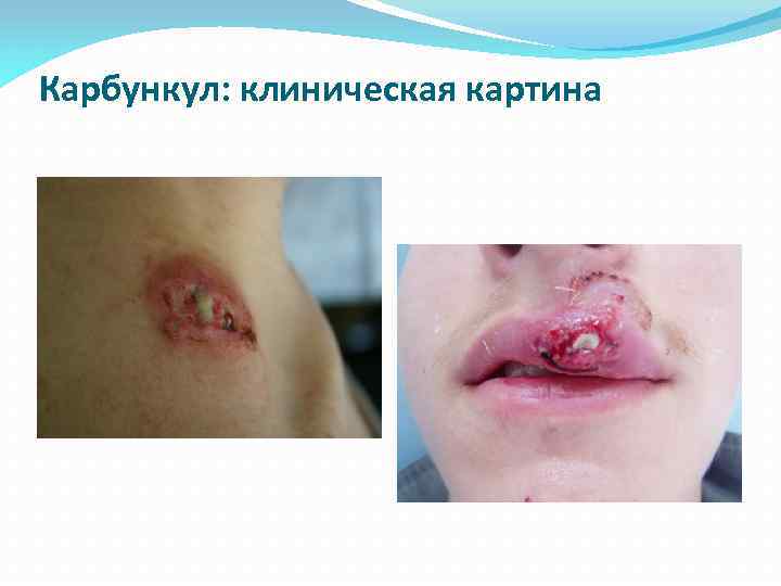Карбункул: клиническая картина 
