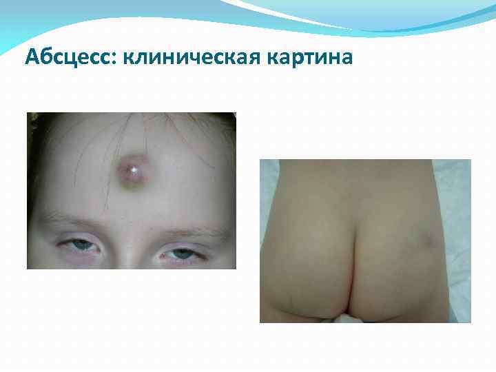 Абсцесс: клиническая картина 