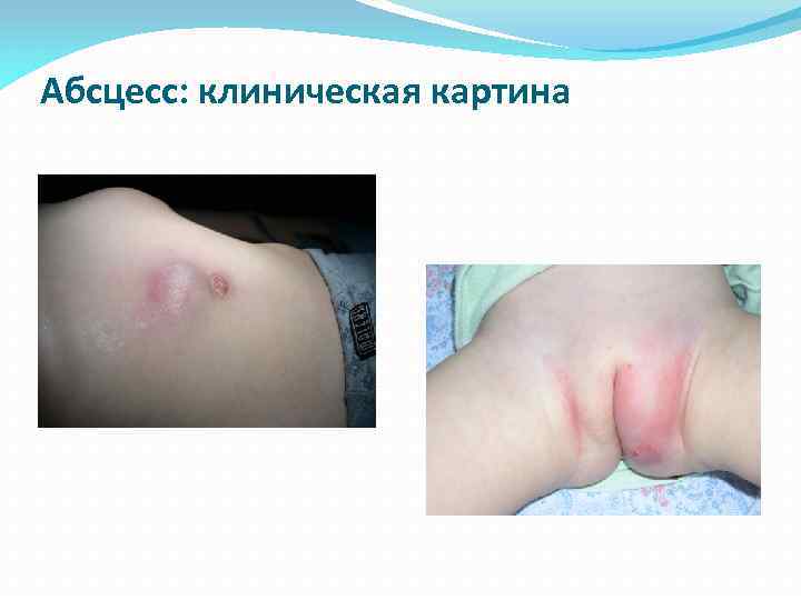 Абсцесс: клиническая картина 