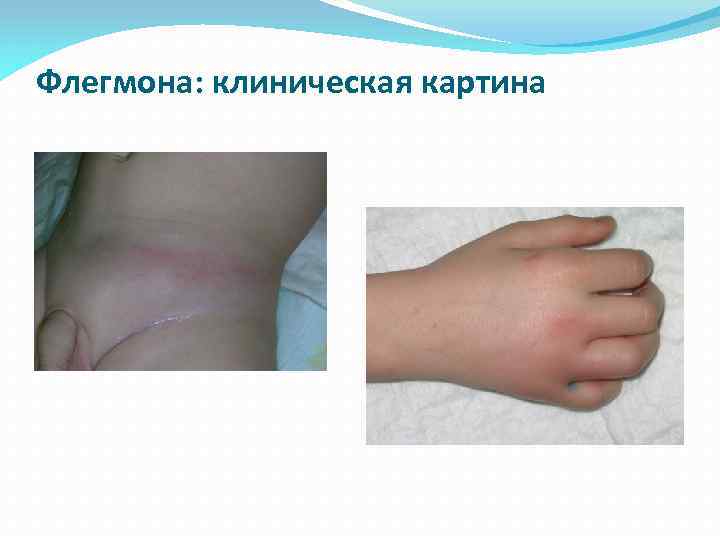 Флегмона: клиническая картина 