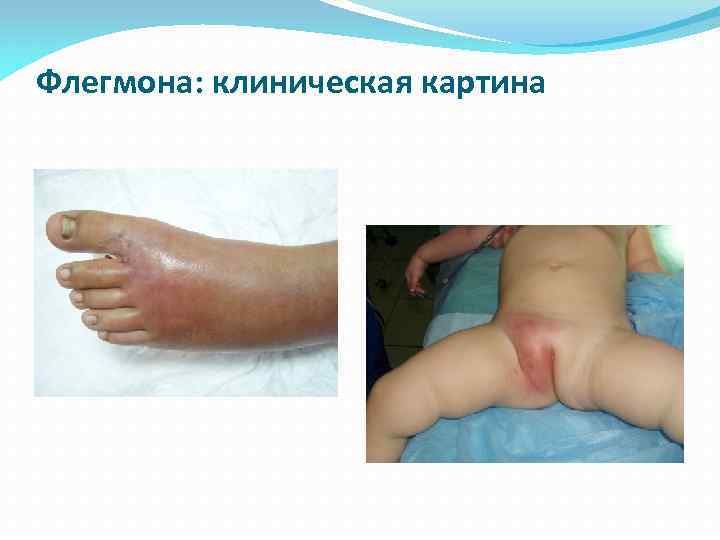 Флегмона: клиническая картина 