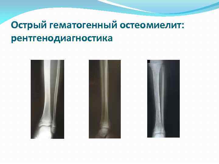 Острый гематогенный остеомиелит: рентгенодиагностика 