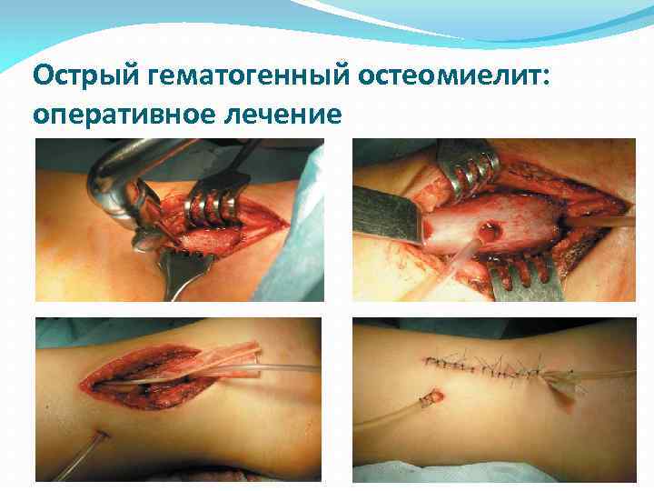 Острый гематогенный остеомиелит: оперативное лечение 