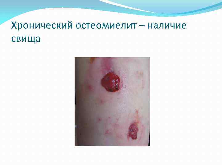 Хронический остеомиелит – наличие свища 