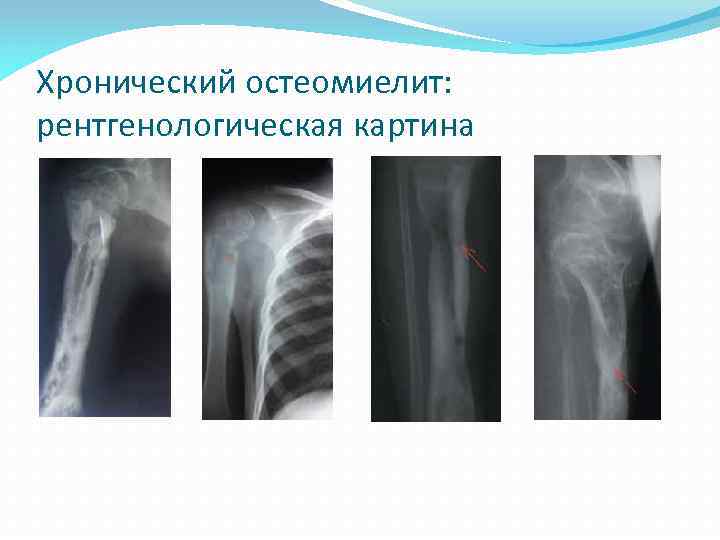 Хронический остеомиелит: рентгенологическая картина 