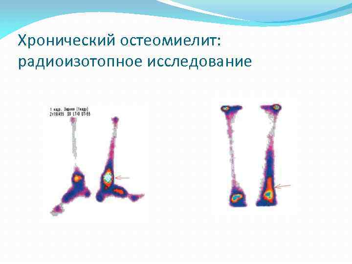 Хронический остеомиелит: радиоизотопное исследование 