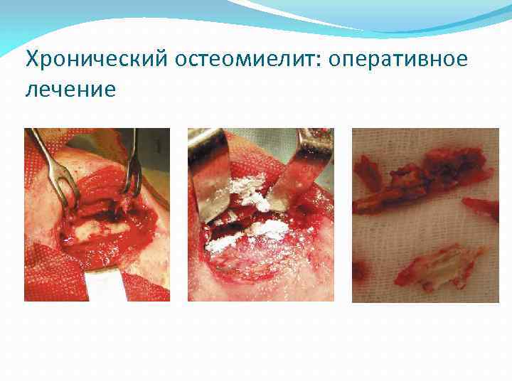 Хронический остеомиелит: оперативное лечение 