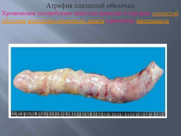 Атрофия слизистой оболочки Хроническое употребление алкоголя приводит к атрофии слизистой оболочки желудочно-кишечного тракта и