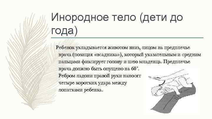 Инородное тело (дети до года) Ребенок укладывается животом вниз, лицом на предплечье врача (позиция