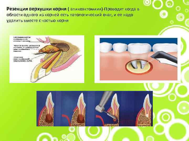 Резекция верхушки корня ( апикоэктомиия)-Проводят когда в области одного из корней есть патологический очаг,