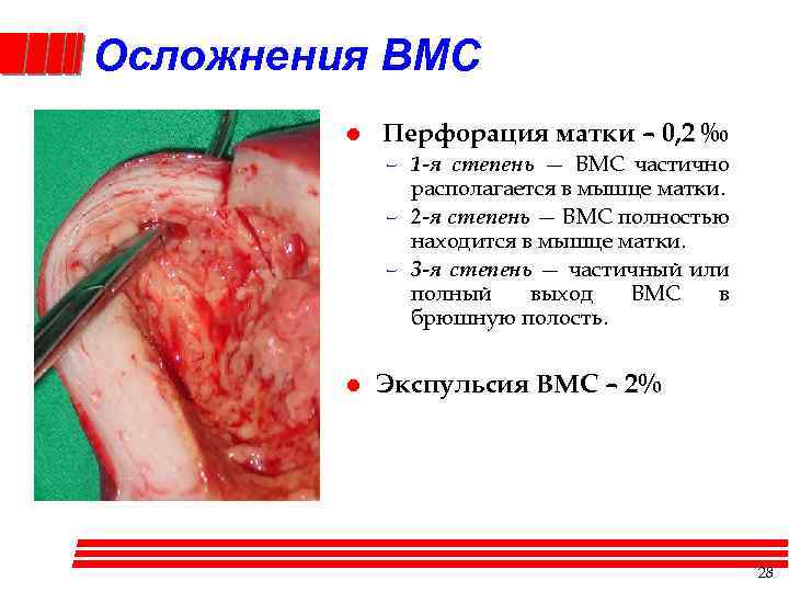 Осложнения ВМС l Перфорация матки – 0, 2 ‰ – 1 -я степень —