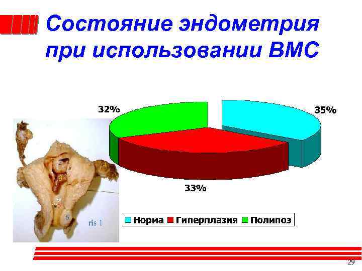 Состояние эндометрия при использовании ВМС 29 