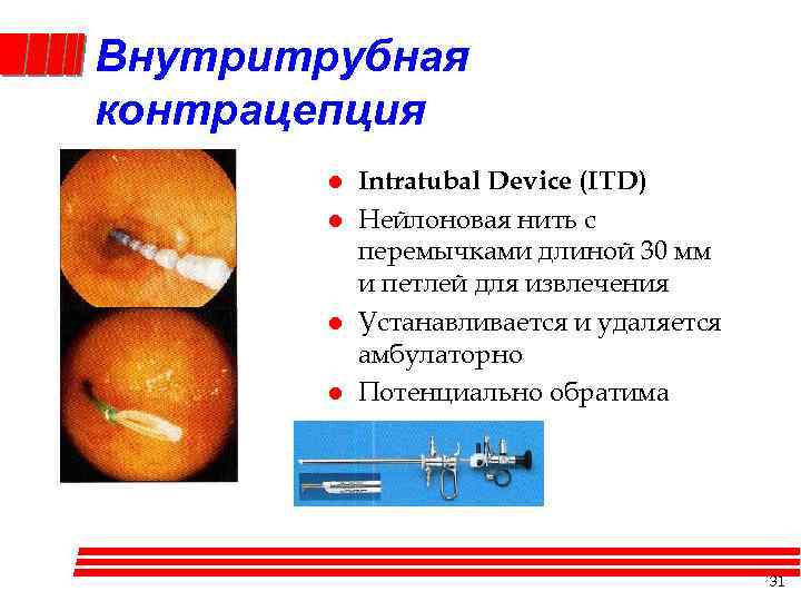 Внутритрубная контрацепция l l Intratubal Device (ITD) Нейлоновая нить с перемычками длиной 30 мм