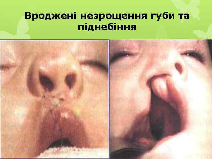 Вроджені незрощення губи та піднебіння 