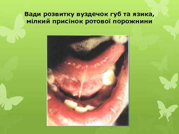 Вади розвитку вуздечок губ та язика, мілкий присінок ротової порожнини 