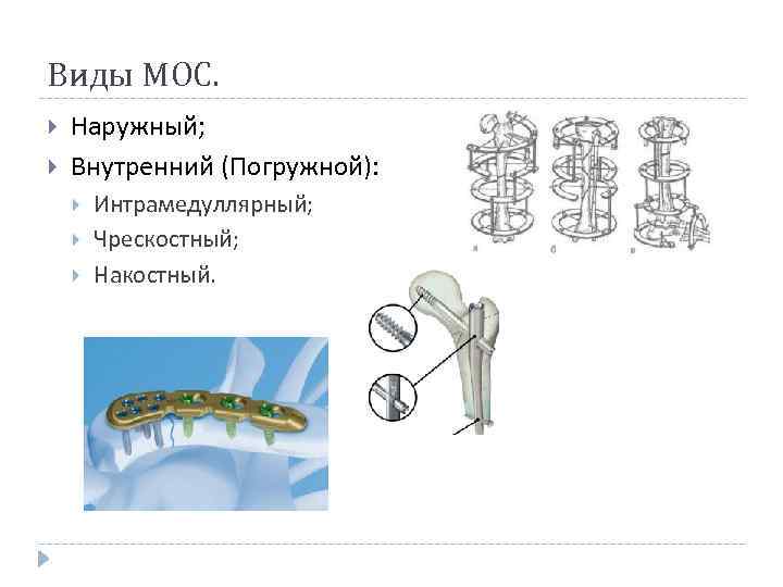 Виды МОС. Наружный; Внутренний (Погружной): Интрамедуллярный; Чрескостный; Накостный. 