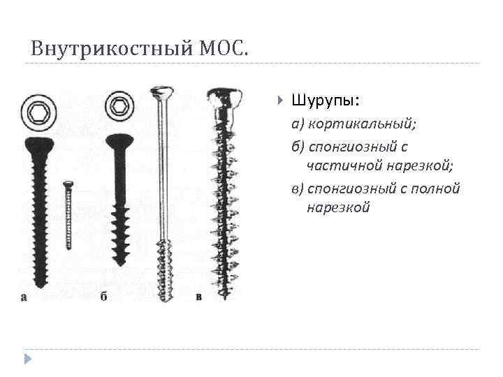 Внутрикостный МОС. Шурупы: а) кортикальный; б) спонгиозный с частичной нарезкой; в) спонгиозный с полной