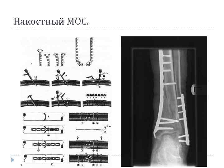 Накостный МОС. 