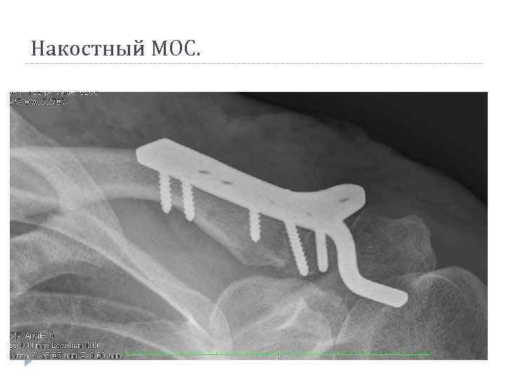 Накостный МОС. 