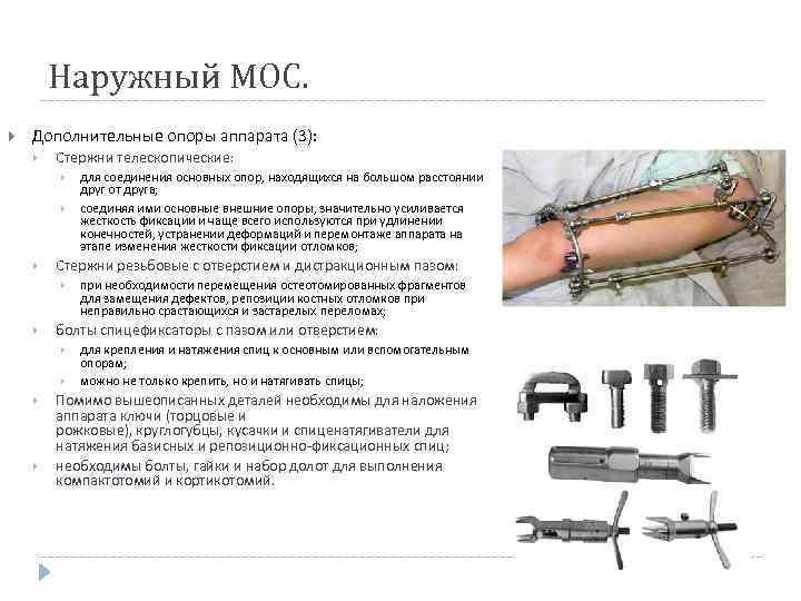Наружный МОС. Дополнительные опоры аппарата (3): Стержни телескопические: Стержни резьбовые с отверстием и дистракционным