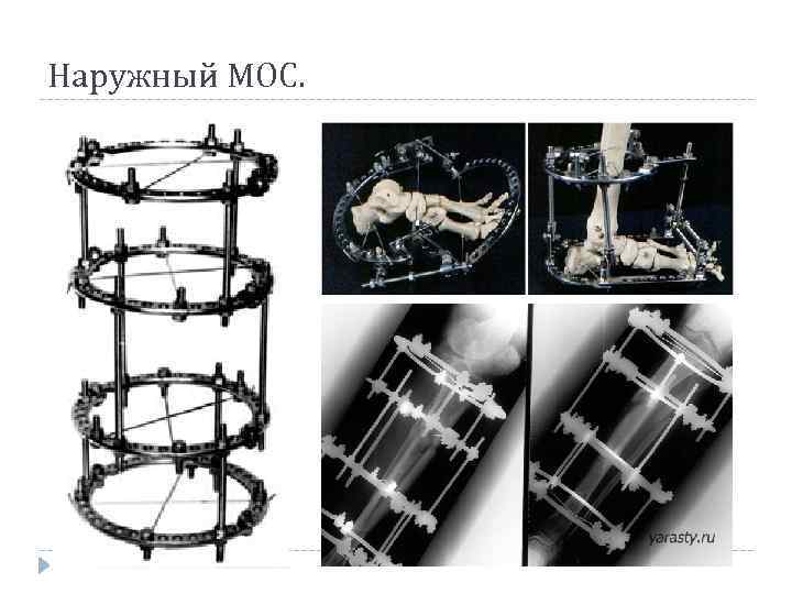 Наружный МОС. 