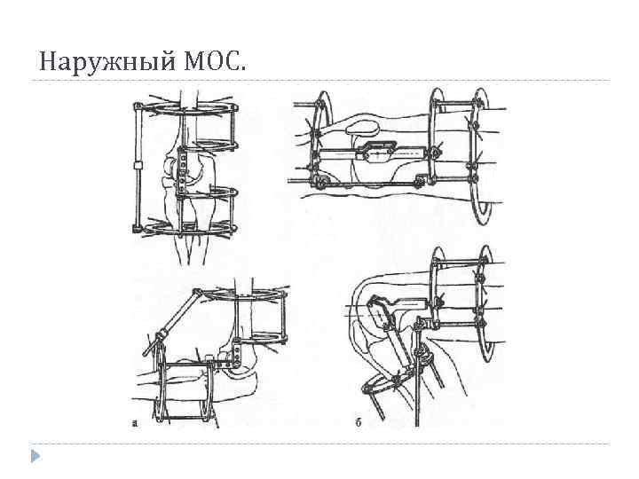 Наружный МОС. 