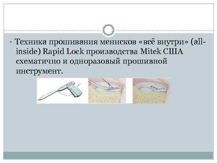  • Техника прошивания менисков «всё внутри» (all- inside) Rapid Lock производства Mitek США