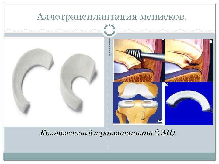 Аллотрансплантация менисков. Коллагеновый трансплантат (CMI). 