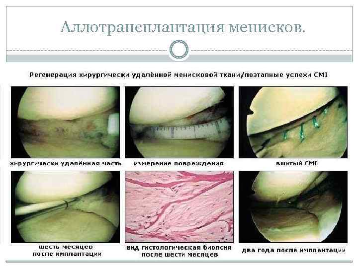 Аллотрансплантация менисков. 