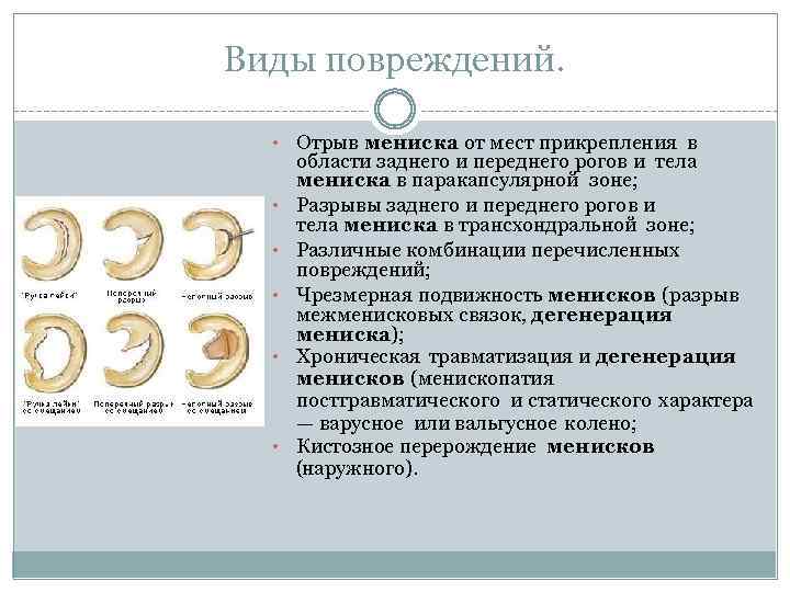 Виды повреждений. • • • Отрыв мениска от мест прикрепления в области заднего и