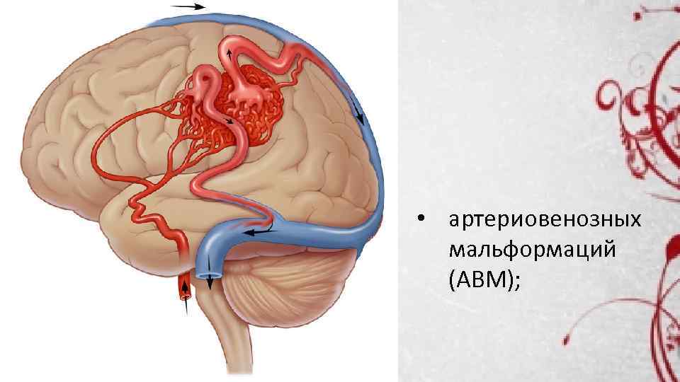 Лечение венозной мальформации. Артериовенозные мальформации. Артериовенозные шунты в головном мозге.