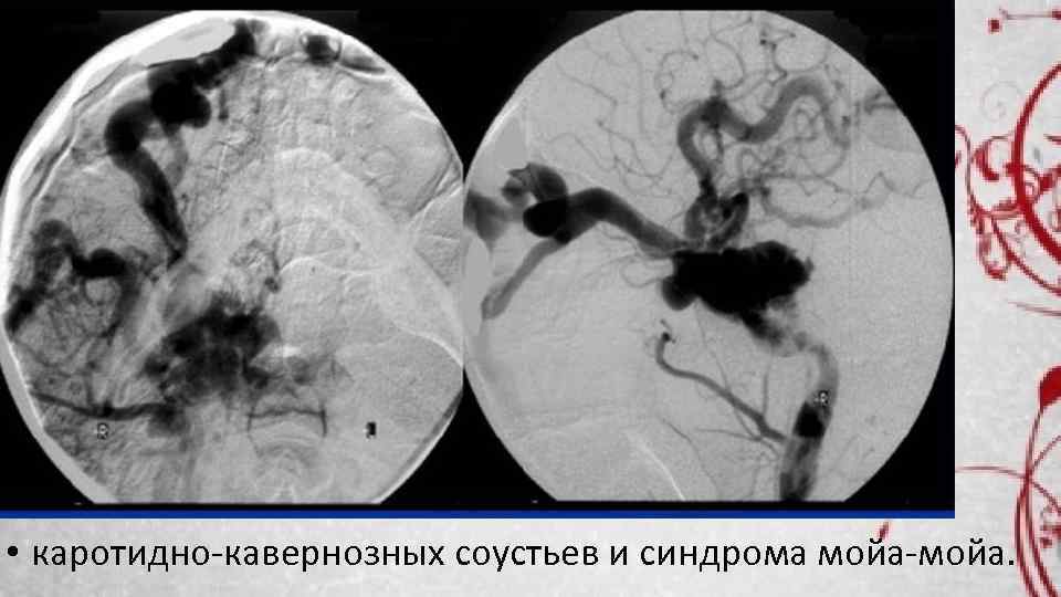  • каротидно кавернозных соустьев и синдрома мойа. 