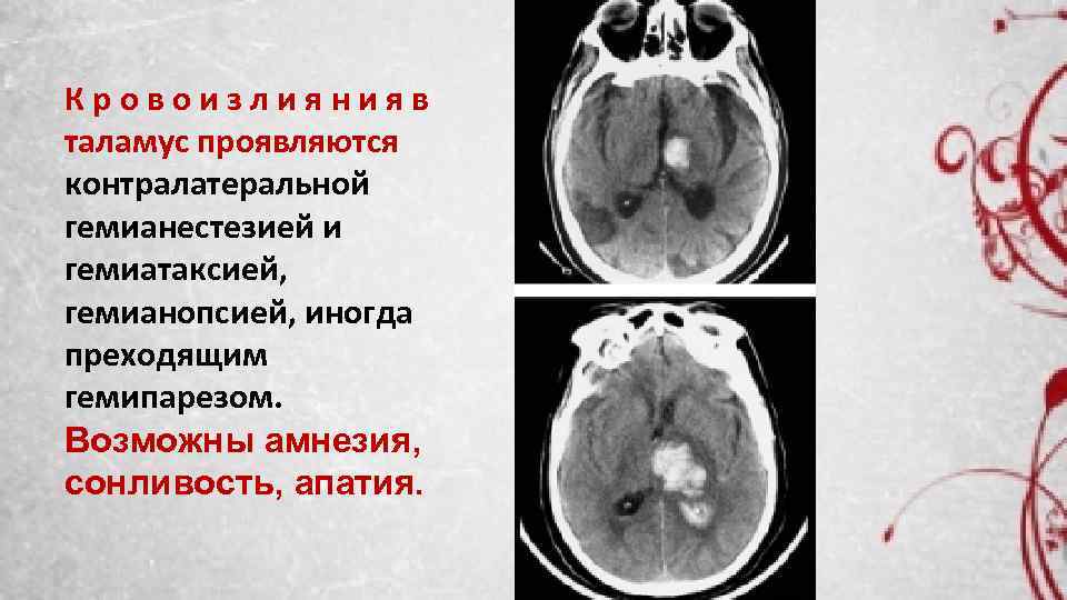 Кровоизлиянияв таламус проявляются контралатеральной гемианестезией и гемиатаксией, гемианопсией, иногда преходящим гемипарезом. Возможны амнезия, сонливость,