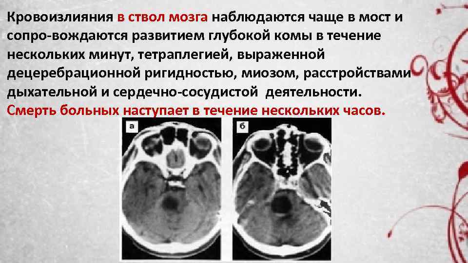 Кровоизлияния в ствол мозга наблюдаются чаще в мост и сопро вождаются развитием глубокой комы