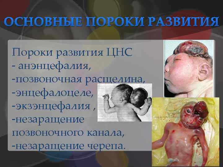 ОСНОВНЫЕ ПОРОКИ РАЗВИТИЯ Пороки развития ЦНС - анэнцефалия, -позвоночная расщелина, -энцефалоцеле, -экзэнцефалия , -незаращение