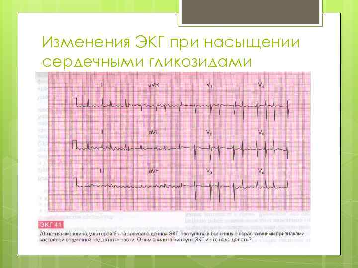 Изменения ЭКГ при насыщении сердечными гликозидами 