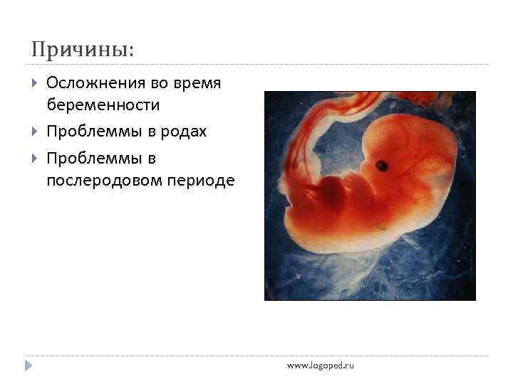 Причины: Осложнения во время беременности Проблеммы в родах Проблеммы в послеродовом периоде www. logoped.