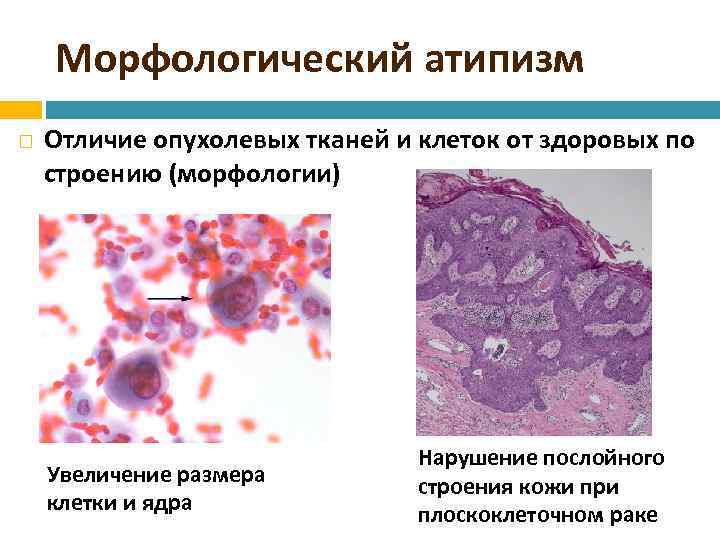 Клеточный атипизм опухоли