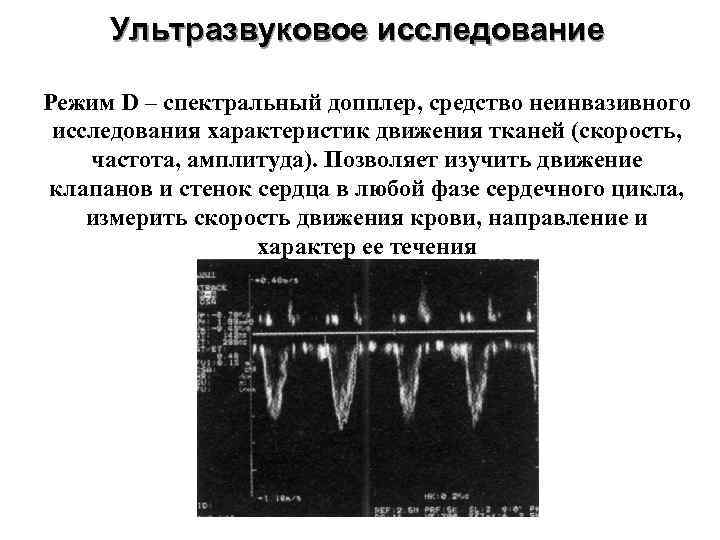 Ультразвуковое исследование Режим D – спектральный допплер, средство неинвазивного исследования характеристик движения тканей (скорость,