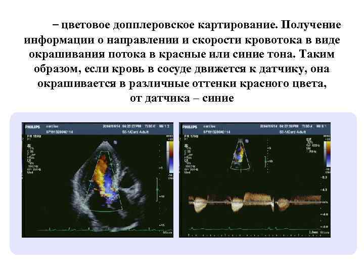 Режим – цветовое допплеровское картирование. Получение информации о направлении и скорости кровотока в виде