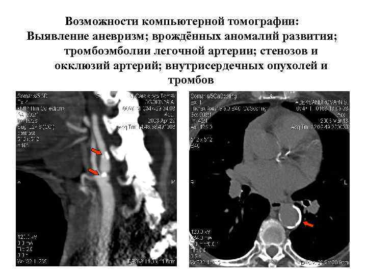 Мультиспиральная компьютерная томография коронарных артерий что это