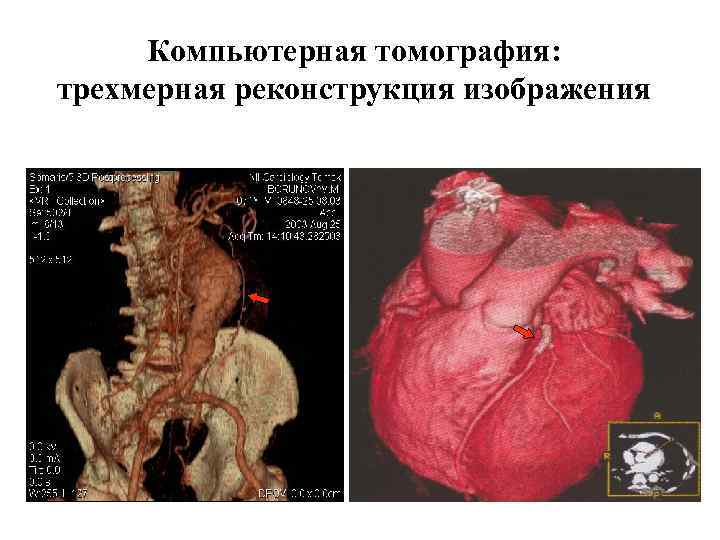 Компьютерная томография: трехмерная реконструкция изображения 